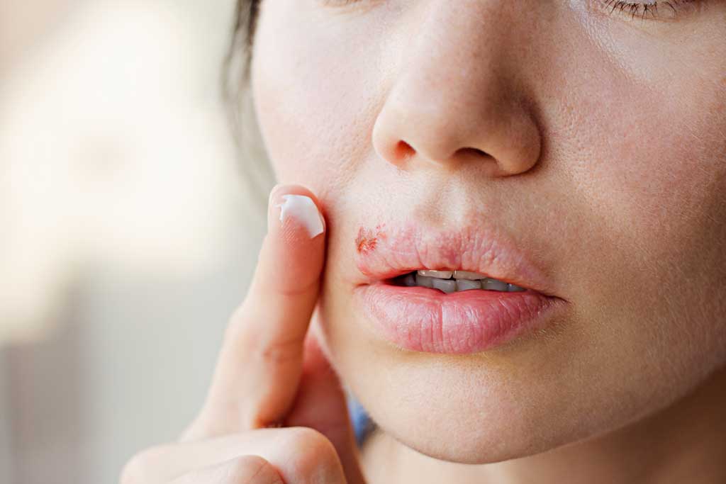 Was hilft gegen Lippenherpes?